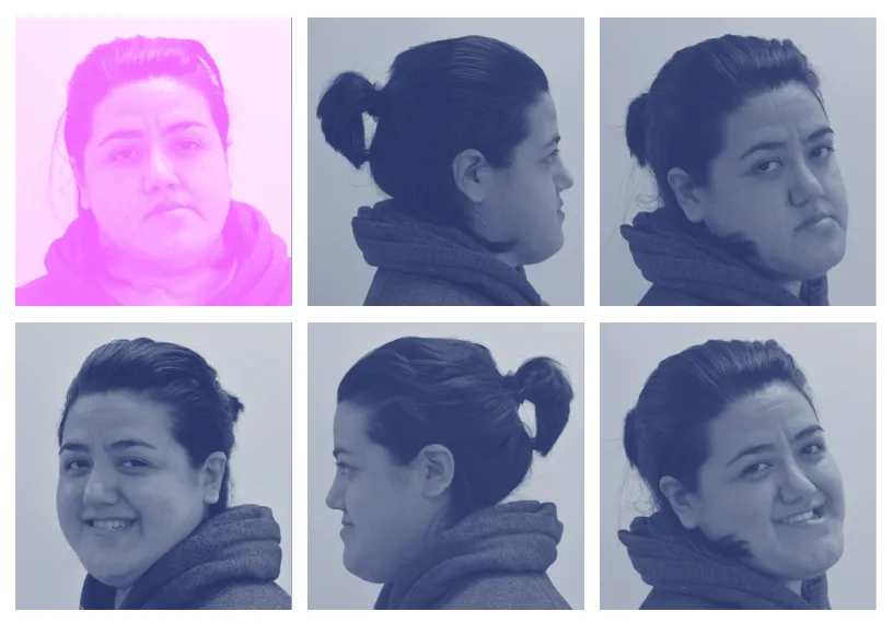 Retrato de paciente en distintos ángulos, testimonio de tratamiento