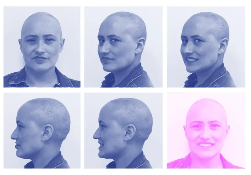 Retrato de paciente en distintos ángulos, testimonio de tratamiento